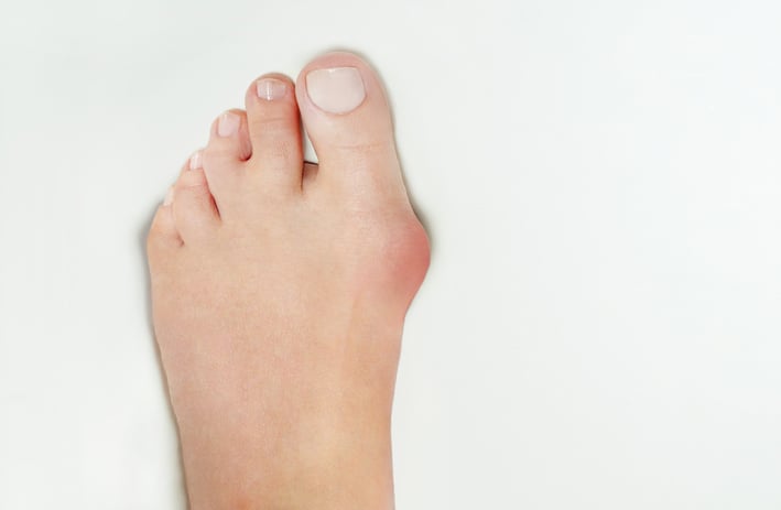 Hallux valgus, bunion in woman foot on white background